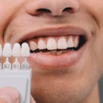 Denizli kliniğimizde uygulanan minimal aşındırmalı lamine diş kaplama süreci.