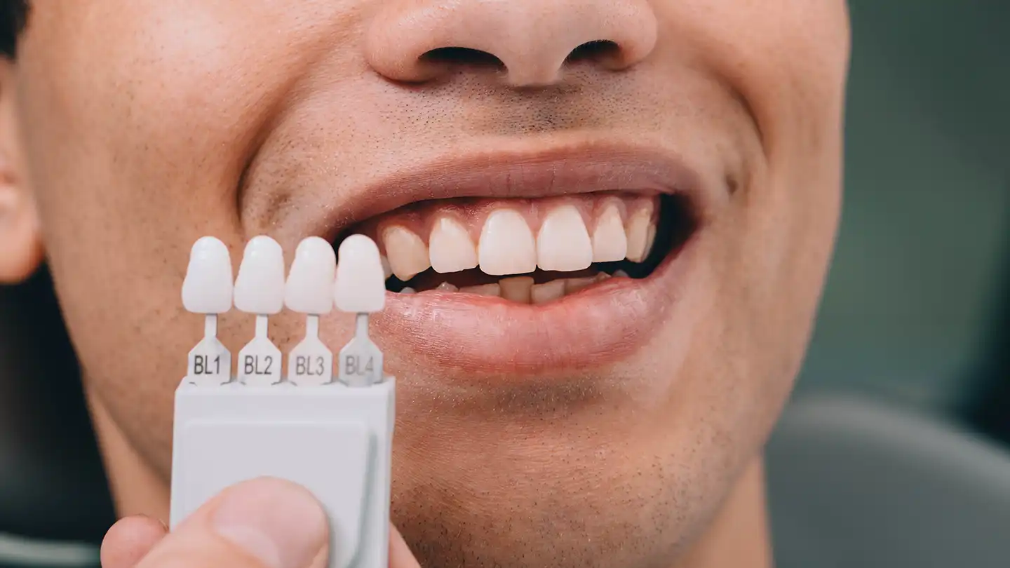 Denizli kliniğimizde uygulanan minimal aşındırmalı lamine diş kaplama süreci.