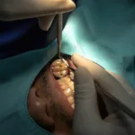 Denizli kliniğimizde gerçekleştirilen dijital planlamalı gömülü diş operasyonları.