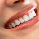 Denizli kliniğimizde uygulanan ışık geçirgenliği yüksek zirkonyum kaplama ve restorasyon süreci.