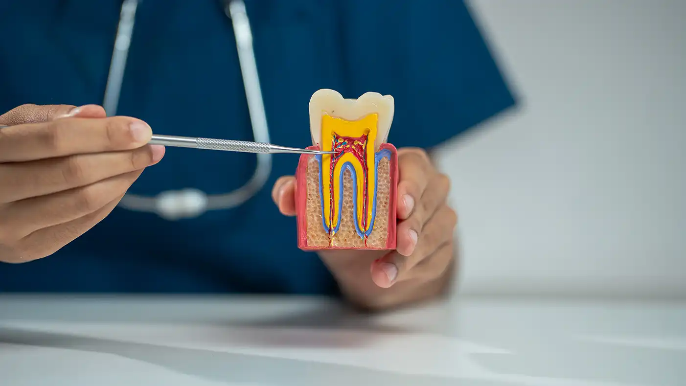 Denizli kliniğimizde diş kurtarma amacıyla uygulanan kanal tedavisi aşamaları ve kök kanal dolgusu.