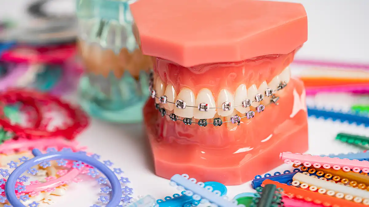 Denizli kliniğimizde diş çapraşıklığı için uygulanan Metal ve Porselen Diş Braketleri ve teknik ortodontik aşamalar.