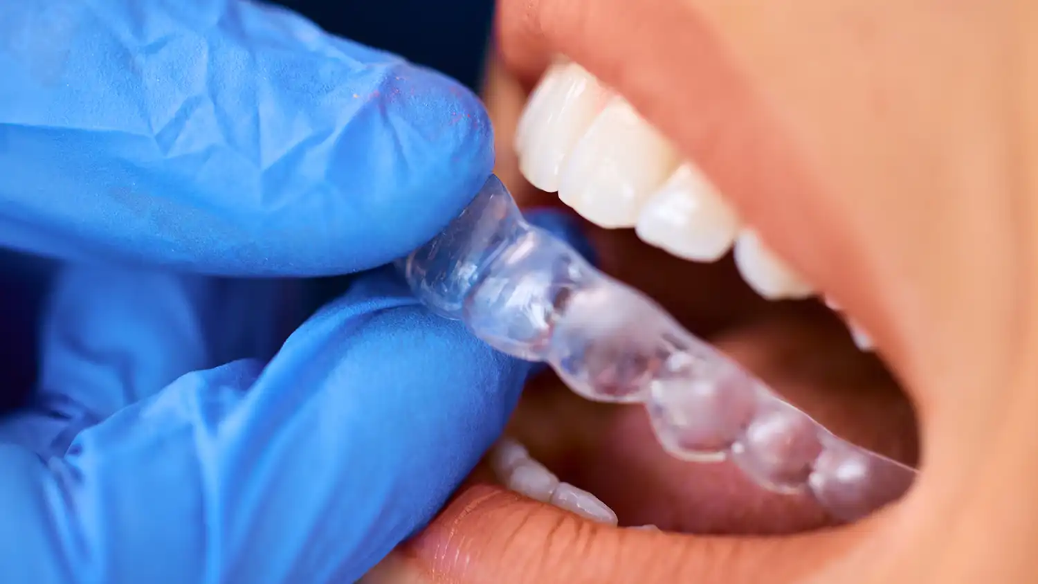 Denizli kliniğimizde uygulanan dijital telsiz ortodonti ve Şeffaf Plak (Invisalign) uygulama aşamaları.