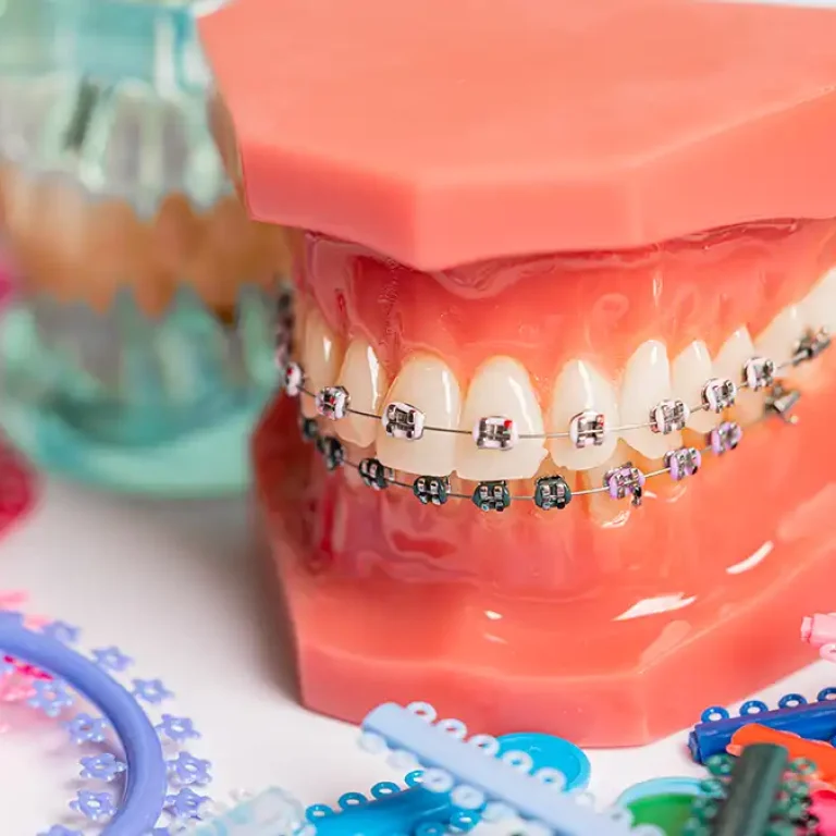 Denizli kliniğimizde diş çapraşıklığı için uygulanan Metal ve Porselen Diş Braketleri ve teknik ortodontik aşamalar.